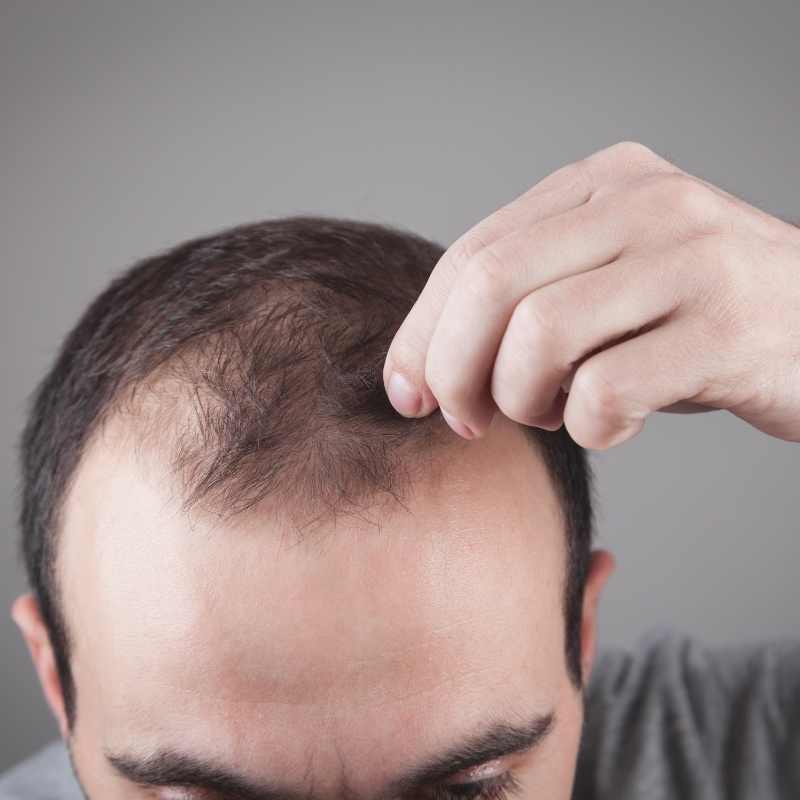 opadanje kose kod muškaraca uzroci