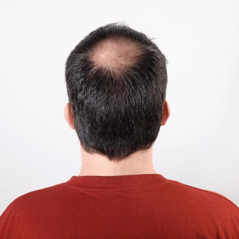 alopecija kod muškaraca